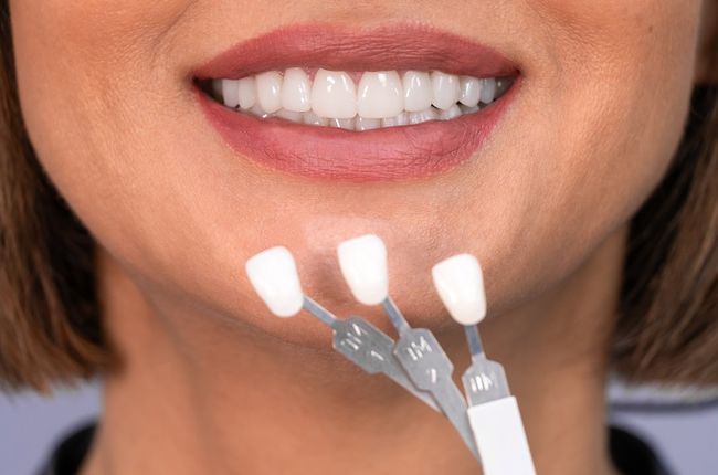 Veneers Veneers
