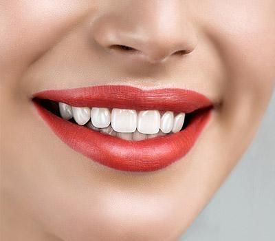 Teeth Whitening Teeth Whitening